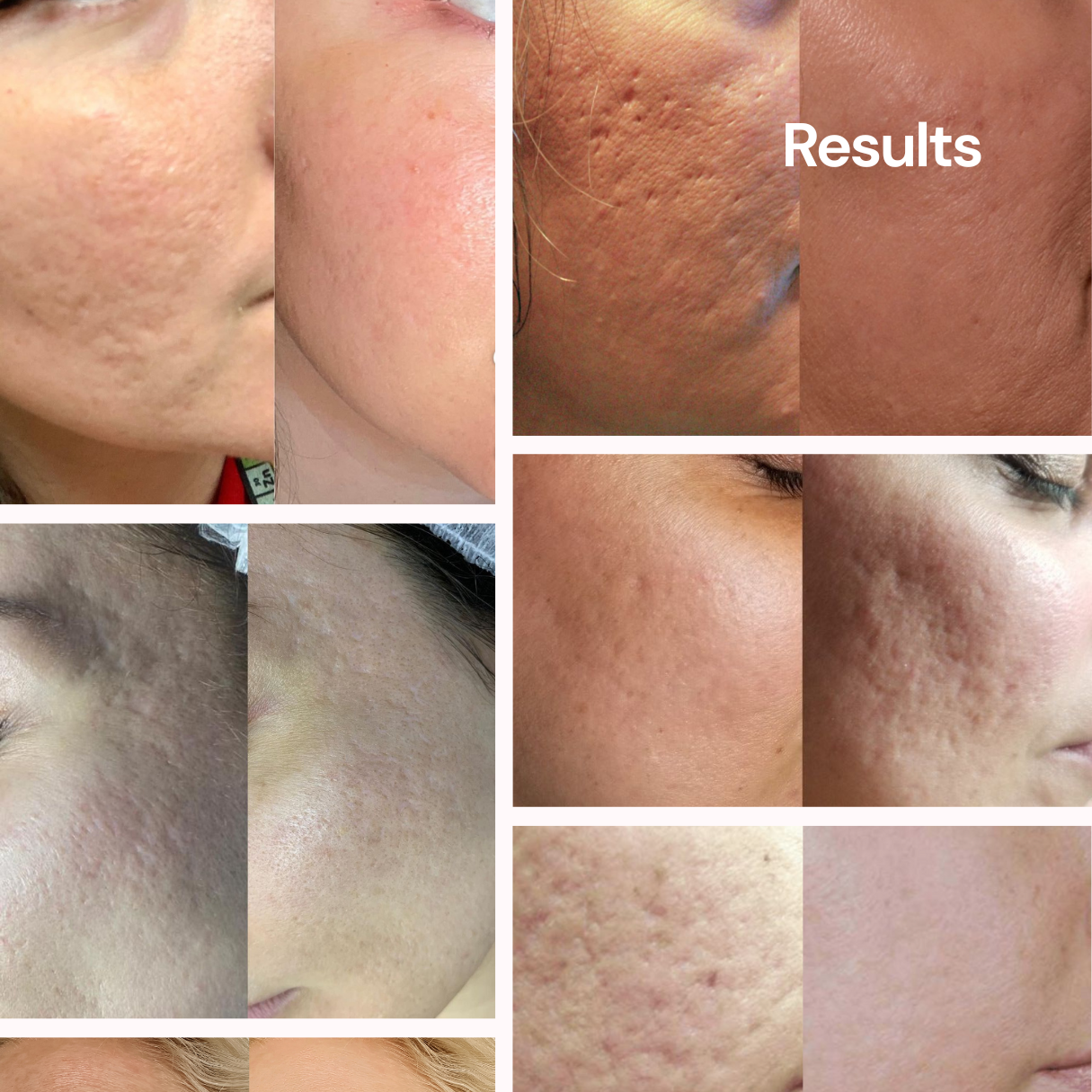 The Ultimate Acne Scar Solution